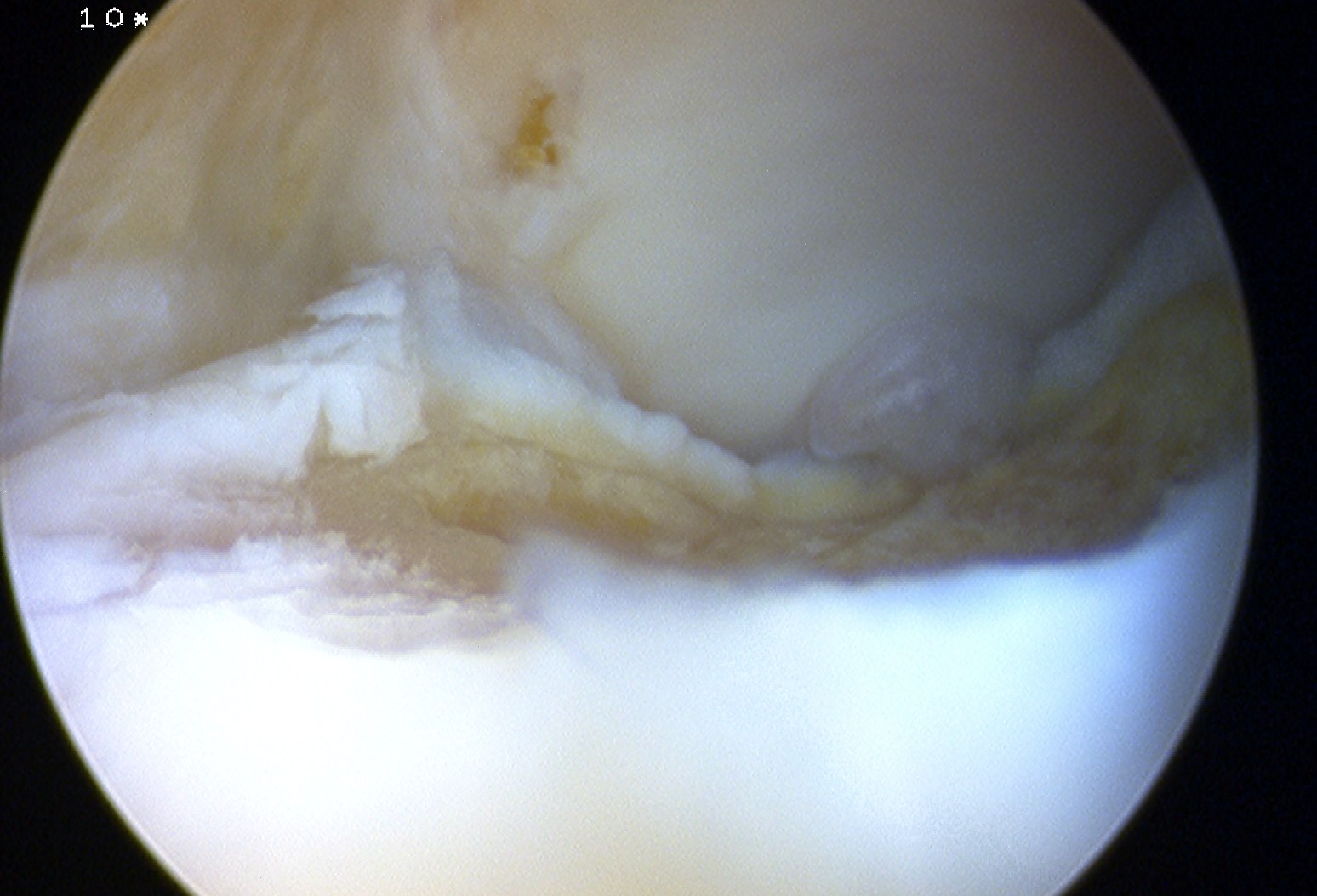 Ankle Scope OCD Grade 4